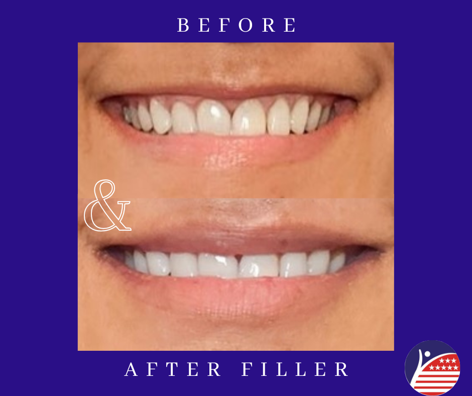before and after images of lip fillers 