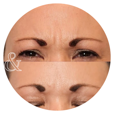 A close-up of diminished fine lines from neurotoxin injections.