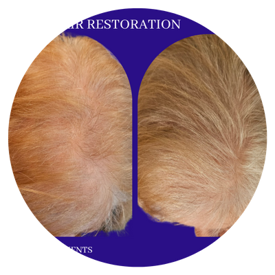 A before & after of a patient's hair after two treatments, showing fuller, healtheir hair.
