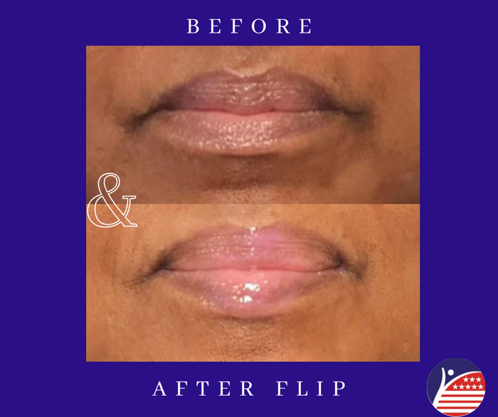 before and after images of lip fillers 