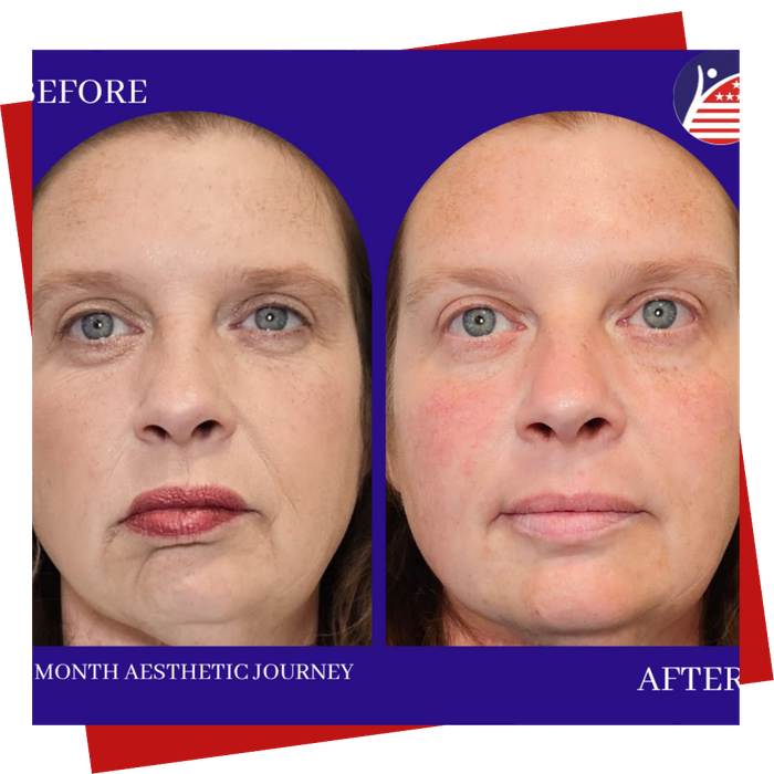 A before & after of a patient's face one month after treatment, with smoother, glowing skin.