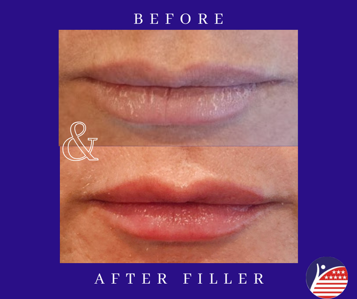 before and after images of lip fillers 