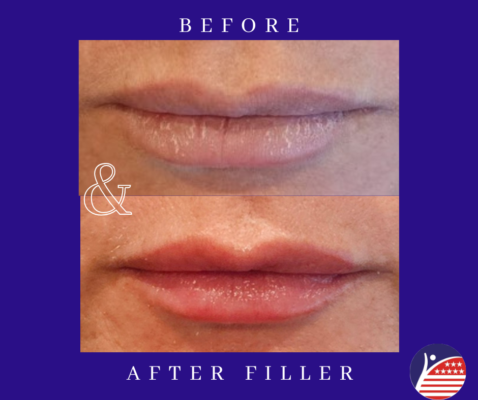 before and after images of lip fillers 