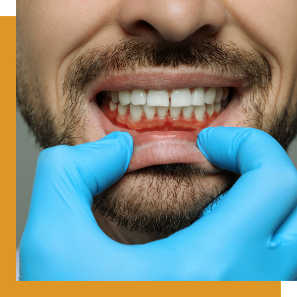 Symptoms Periodontal Disease 3.png