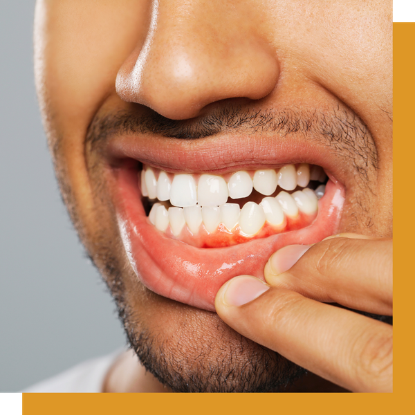 Symptoms Periodontal Disease 4.png