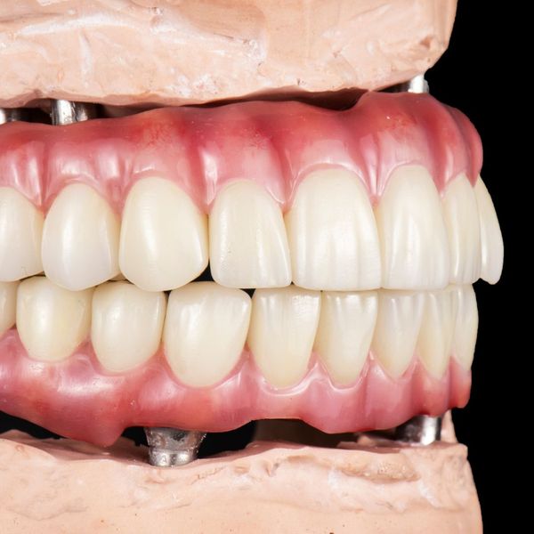 Mouth showing dental implants