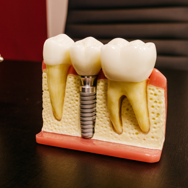 A dental implant