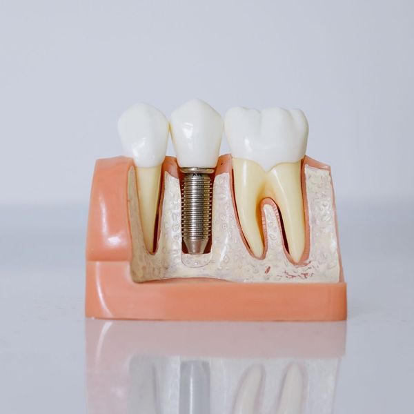 Model of Dental Implants The Benefits of Dental Implants Over Traditional Dentures3.jpg