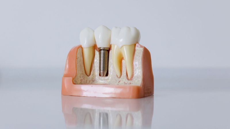 The Benefits of Dental Implants Over Traditional Dentures - Hero.jpg