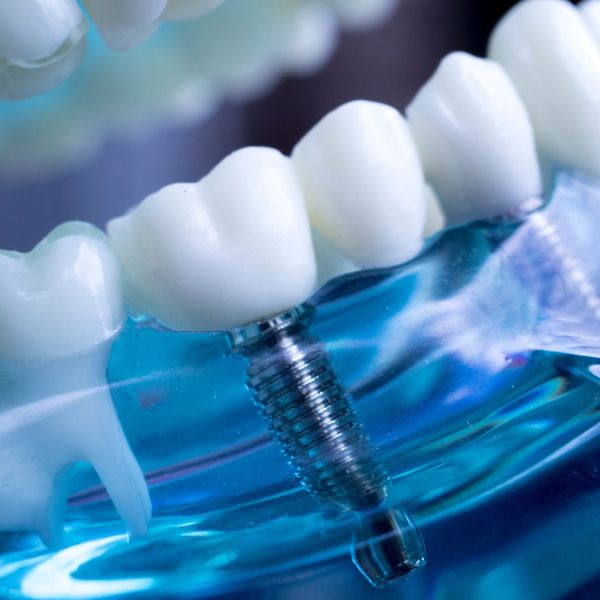 Dental Implant Model The Benefits of Dental Implants Over Traditional Dentures1.jpg