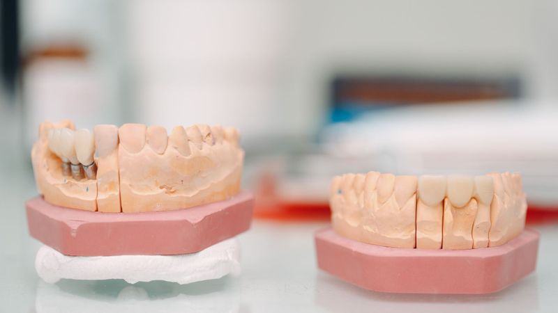 Mouth casts showing dental implants