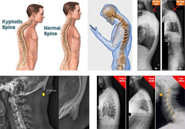 Different images showing the effects of bad posture due to using devices