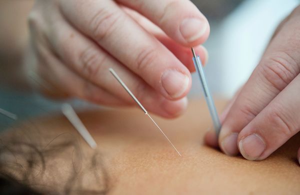 Closeup of acupuncture needles being inserted into skin