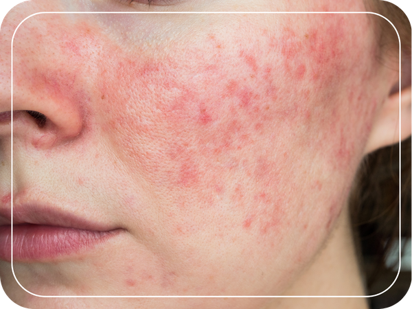 young woman with Acne Rosacea