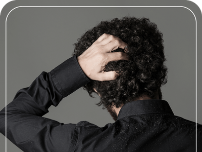 Man scratching his itchy scalp with Dandruff