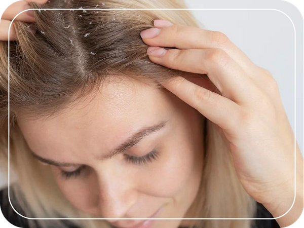 Woman scratching her itchy scalp with Dandruff