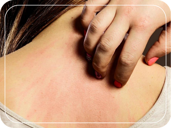 woman scratching at Rash Eczema 