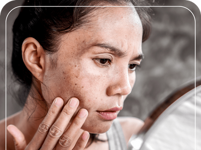 woman with Hyperpigmented Spots