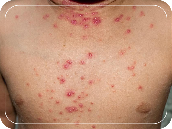 man with Herpes Molluscum Contagiosum