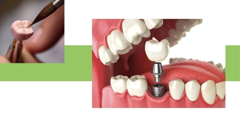 implant Crowns img 2.jpg