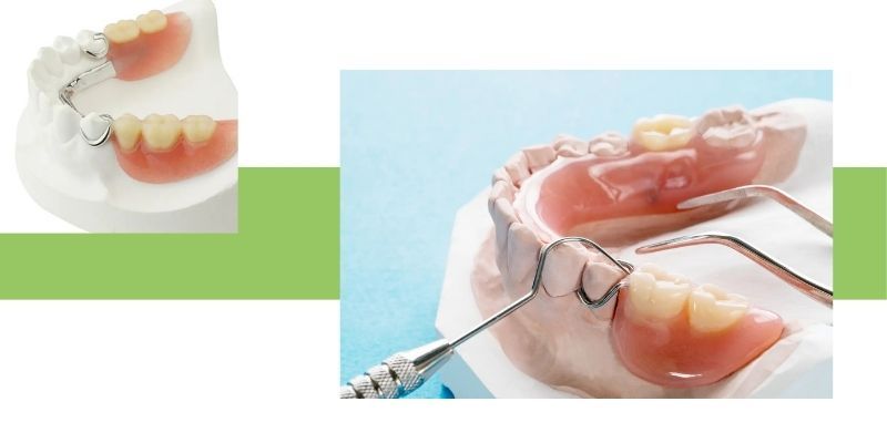 Partial Dentures Img 2.jpg