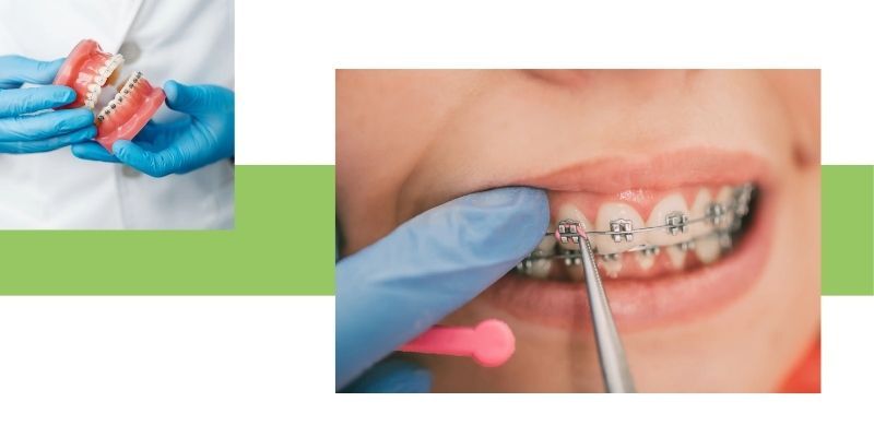 Dental Braces img 2.jpg