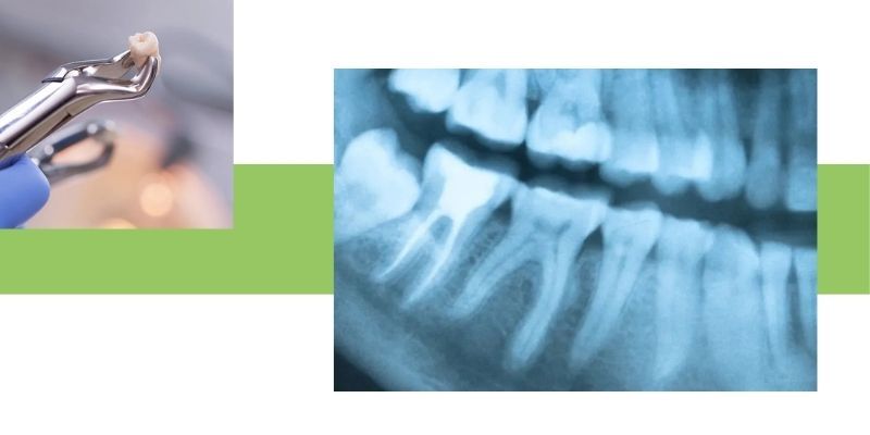 Extractions IMG 2.jpg