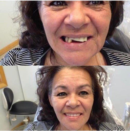 before and after broken teeth fixed