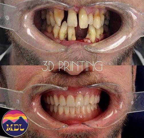 before and after teeth fixing