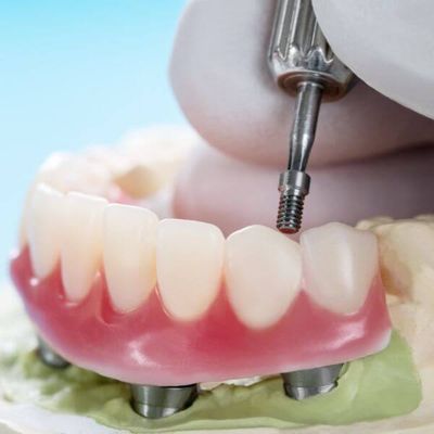 dental implant-supported dentures