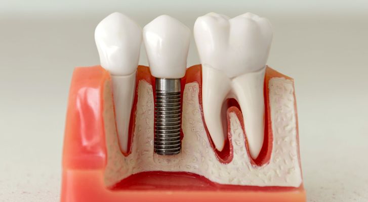 close up of dental implant example