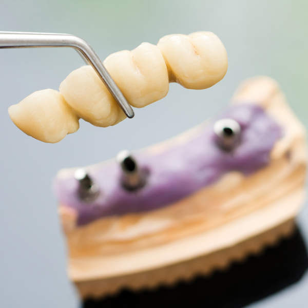 5 Things We Dont Do in Dental Restorations - Image 4.png