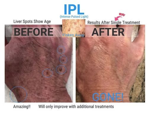 IPL Before and After.jpg