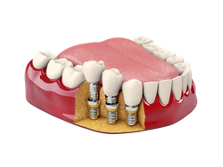 DentalImplants-image3.png