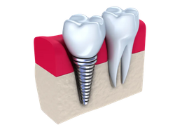 DentalImplants-image4 (1).png