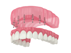 DentalImplants-image5.png
