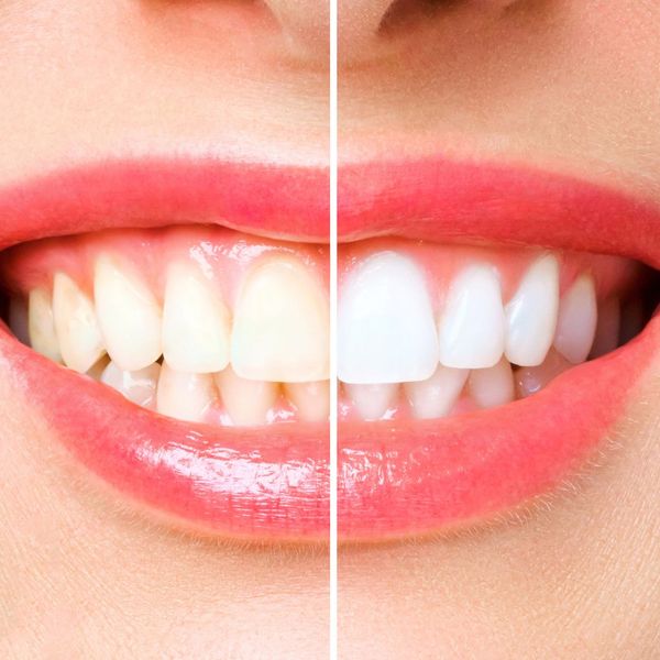 before_after teeth whitening
