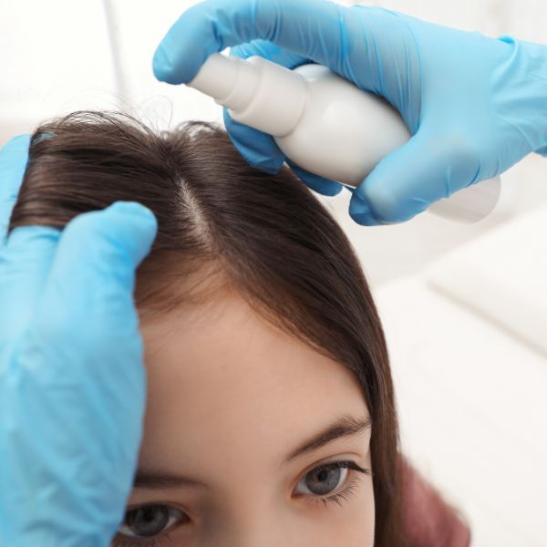 lice spray treatment