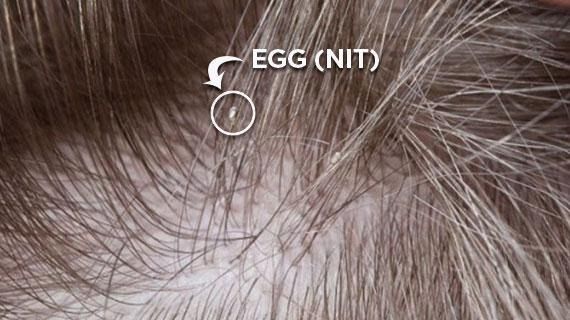 lice egg (nit)
