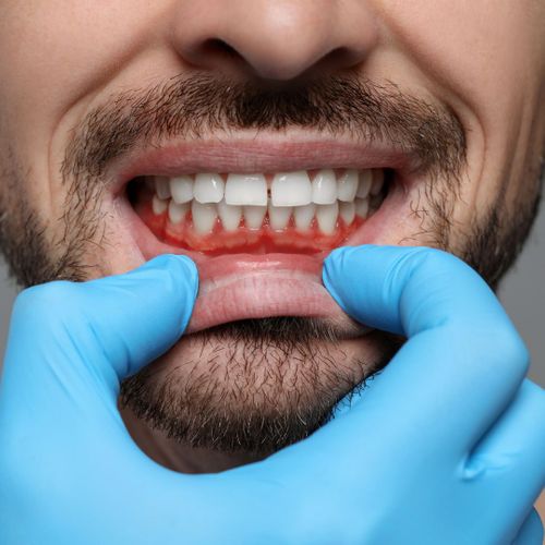 Red, Irritated Gums Understanding Gum Disease1.jpg