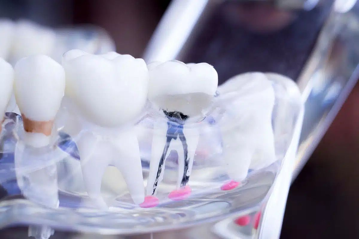 closeup of a root canal mockup display closeup of a root canal mockup display