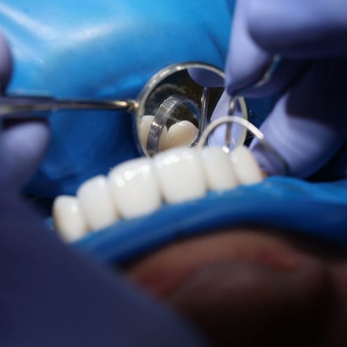 tooth cleaning tooth cleaning