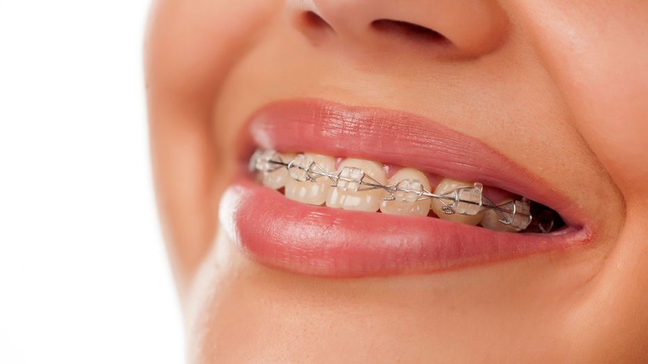 M36950 - John S Walker - 4 Reasons Braces Are Worth The Price featured img.jpg