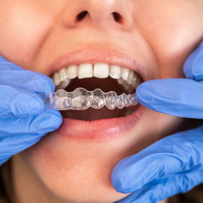 Dentist putting clear aligners into patients mouth