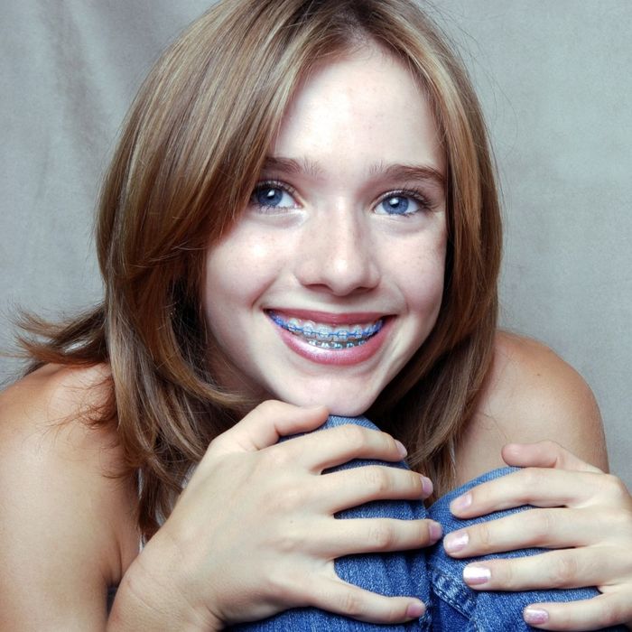 young woman smiling with braces young woman smiling with braces