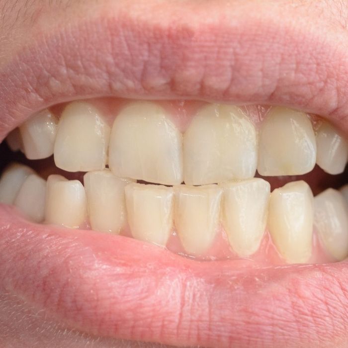 closeup of person with crossbite and crowded teeth closeup of person with crossbite and crowded teeth