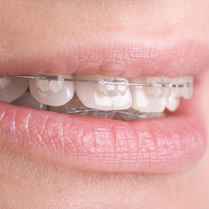 person with overbite and braces person with overbite and braces