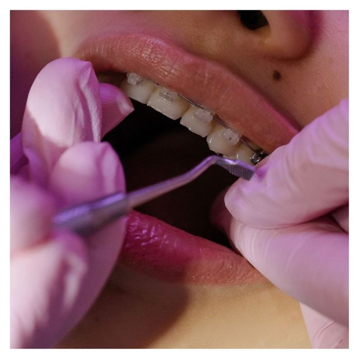 Invisalign vs. Metal Braces - 3.jpg