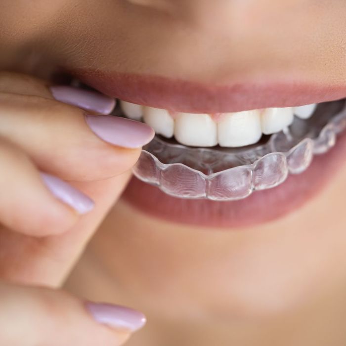 clear aligners