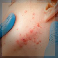 Image of acne